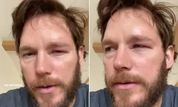 Chris Pratt mostra rosto inchado após ser picado por abelha