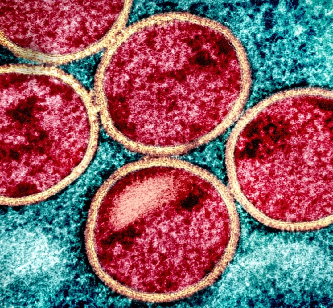 Saúde confirma primeiro caso de nova cepa de mpox no Brasil