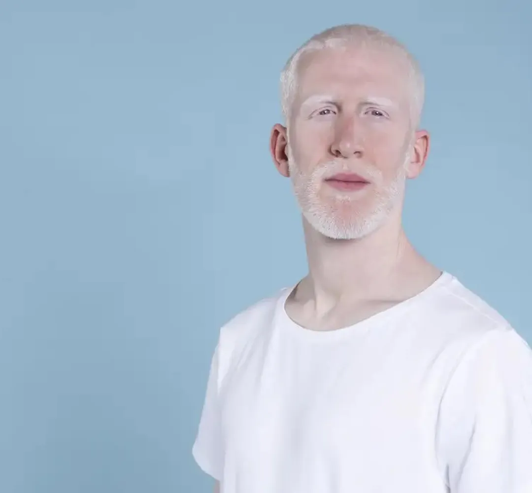 albino