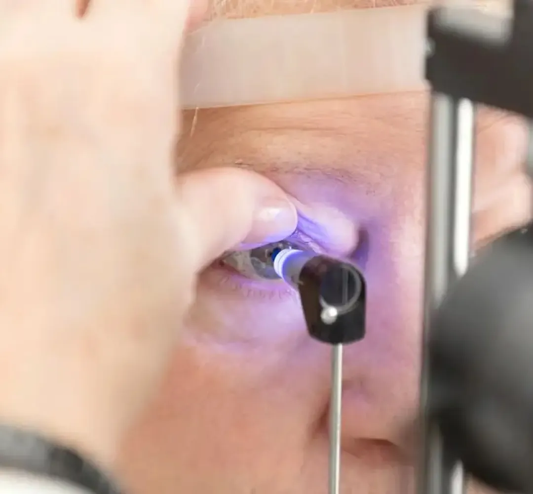 Glaucoma