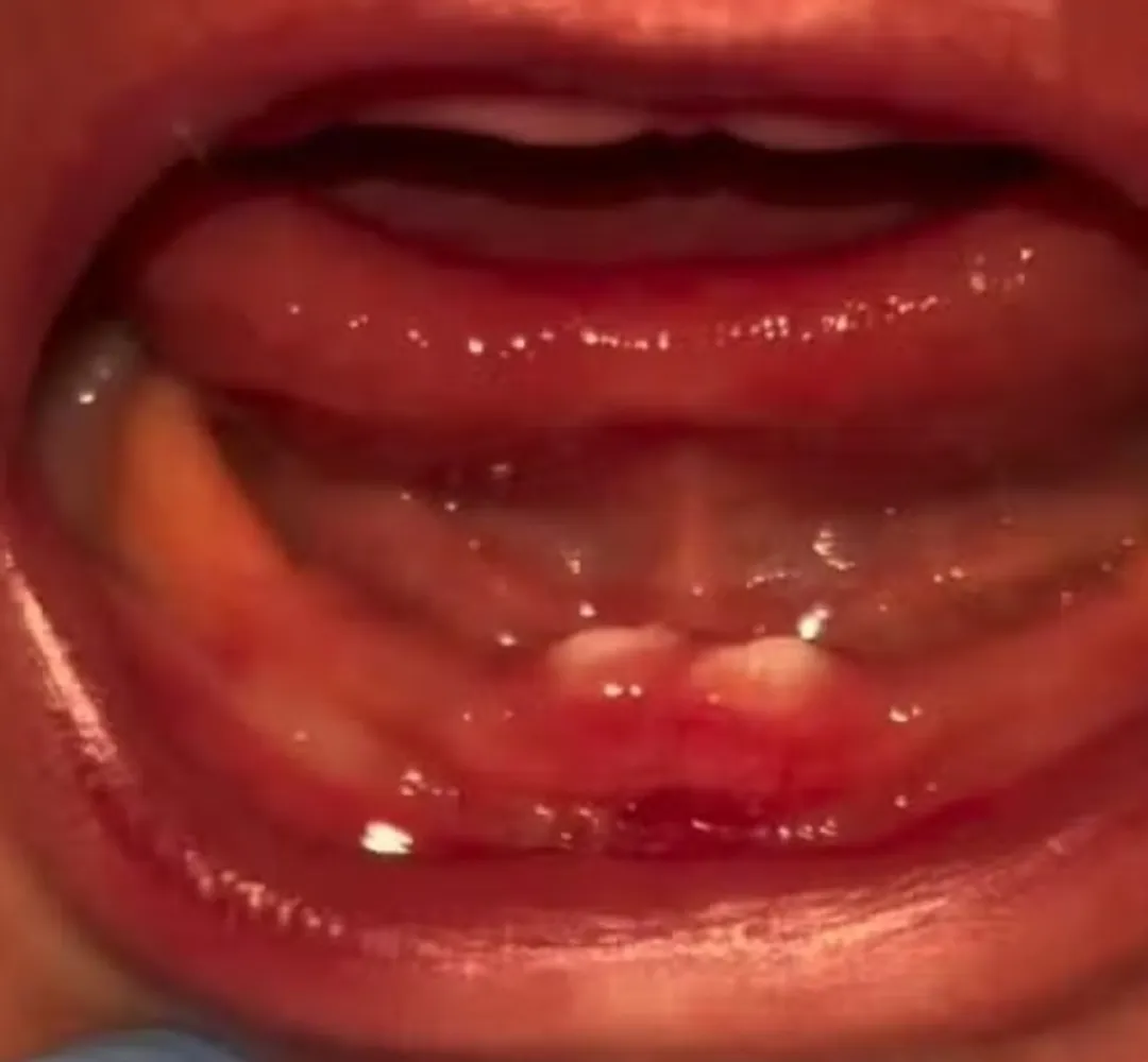 DENTES
