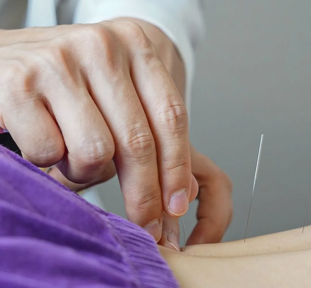 Acupuntura