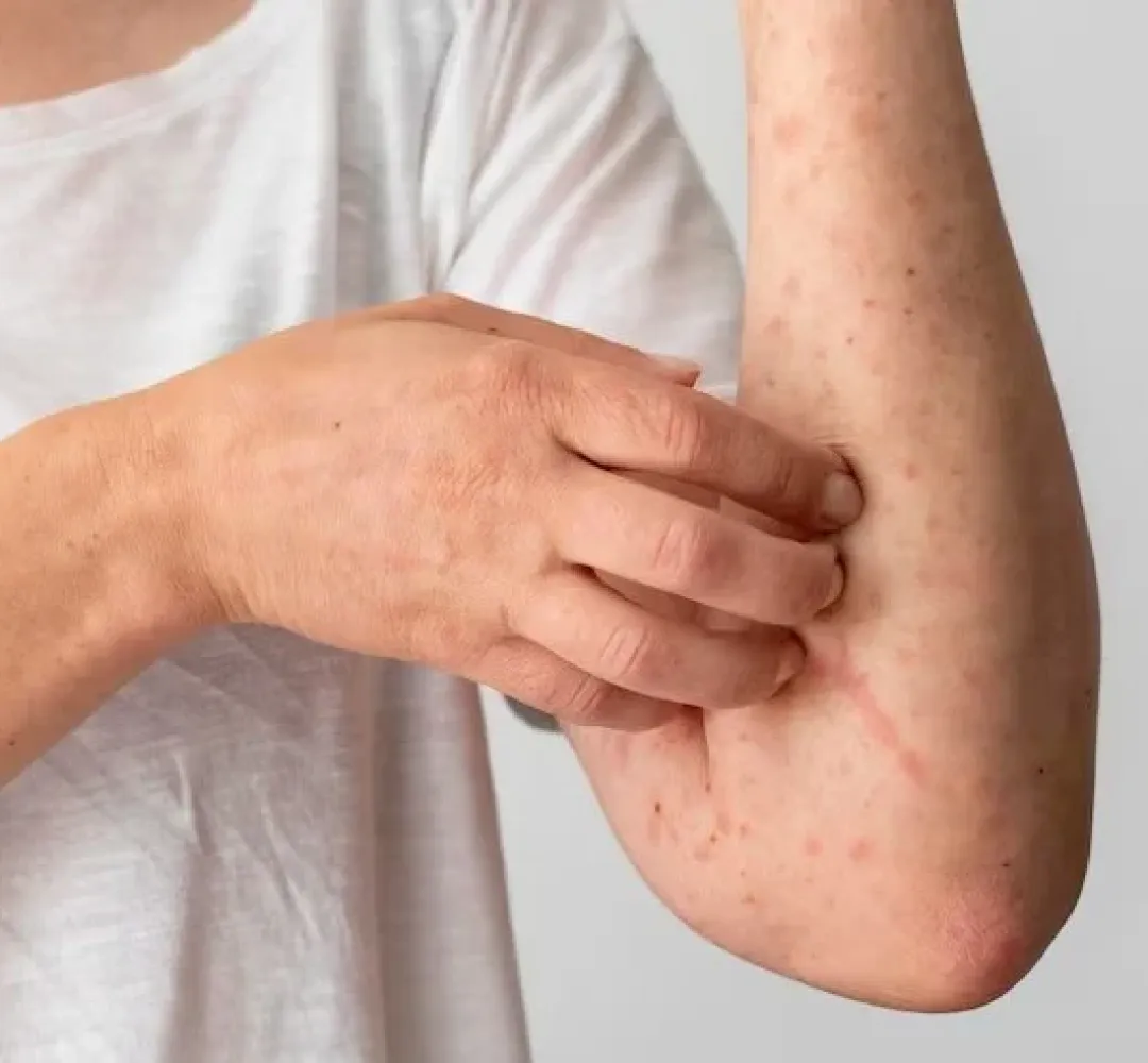 RS confirma primeiro caso de Mpox