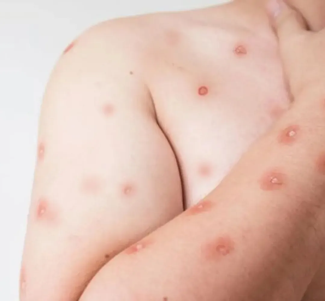 mpox