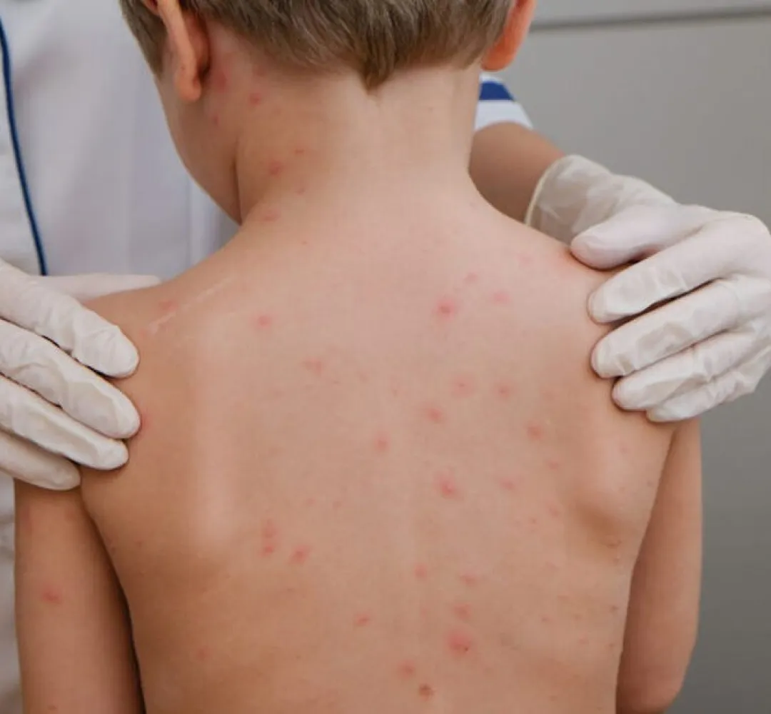 Palotina registra 3 casos de meningite